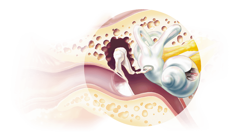Sensorineural_hearing_loss_768x445