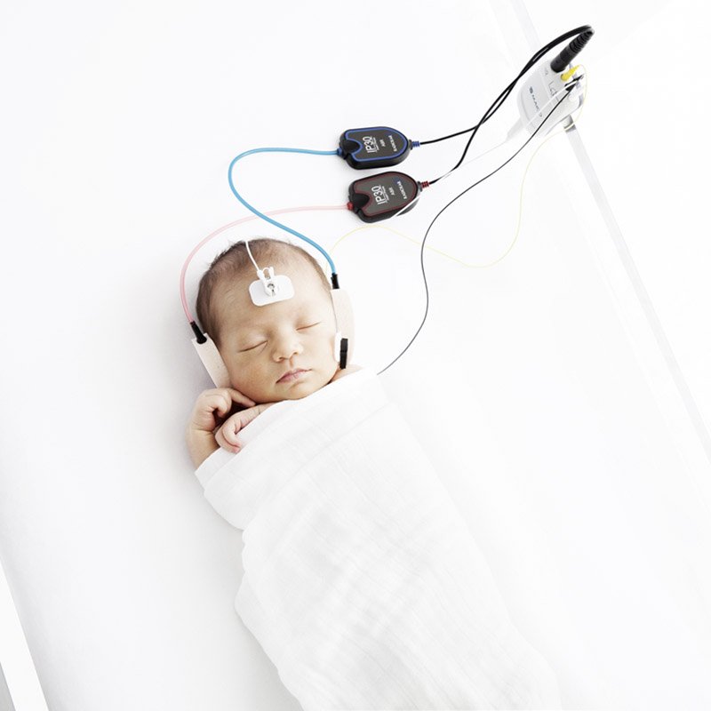 A binaural automated ABR method is used while testing a sleeping baby with MAICO easyScreen and Sanibel Infant EarCup